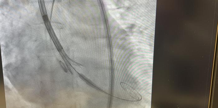 Imagen obtenida mediante rayos X durante una intervención cardiaca en la que se implanta un stent para mantener abierto un vaso sanguíneo.