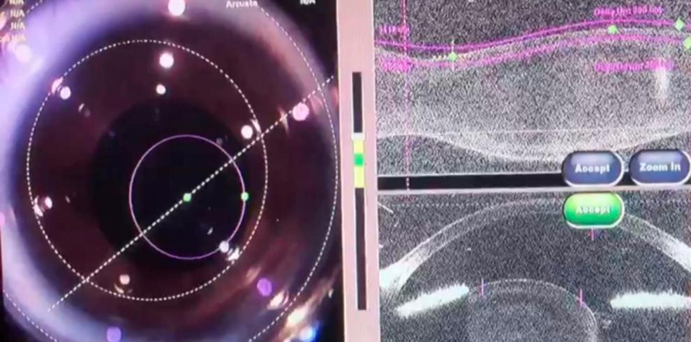 El servicio de Oftalmología del Clínico, pionero en implantar una nueva técnica quirúrgica para el tratamiento de anomalías cristalinianas y cataratas en niños